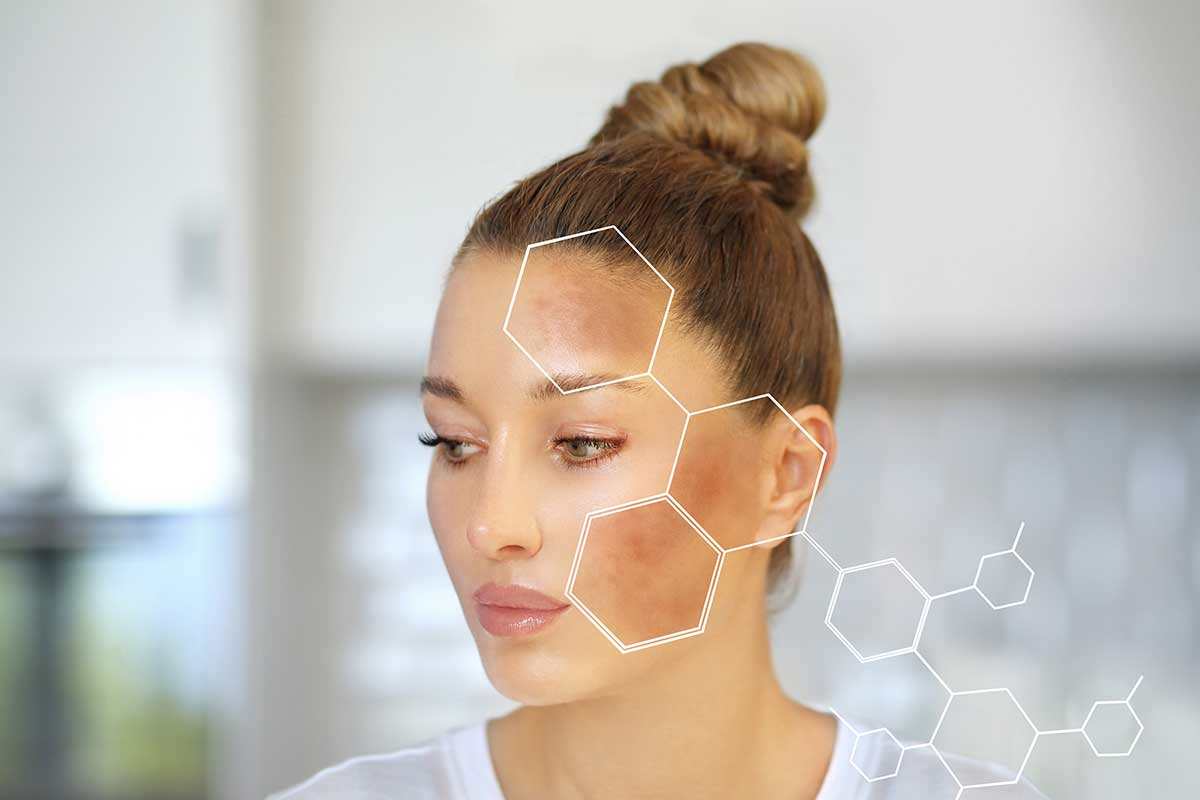 Melasma: Qué es, Causas, Tratamientos y Cómo Aclarar