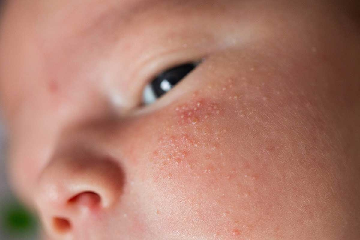 Eccema y Brote de Calor: Causas, Síntomas y Tratamientos Eficaces