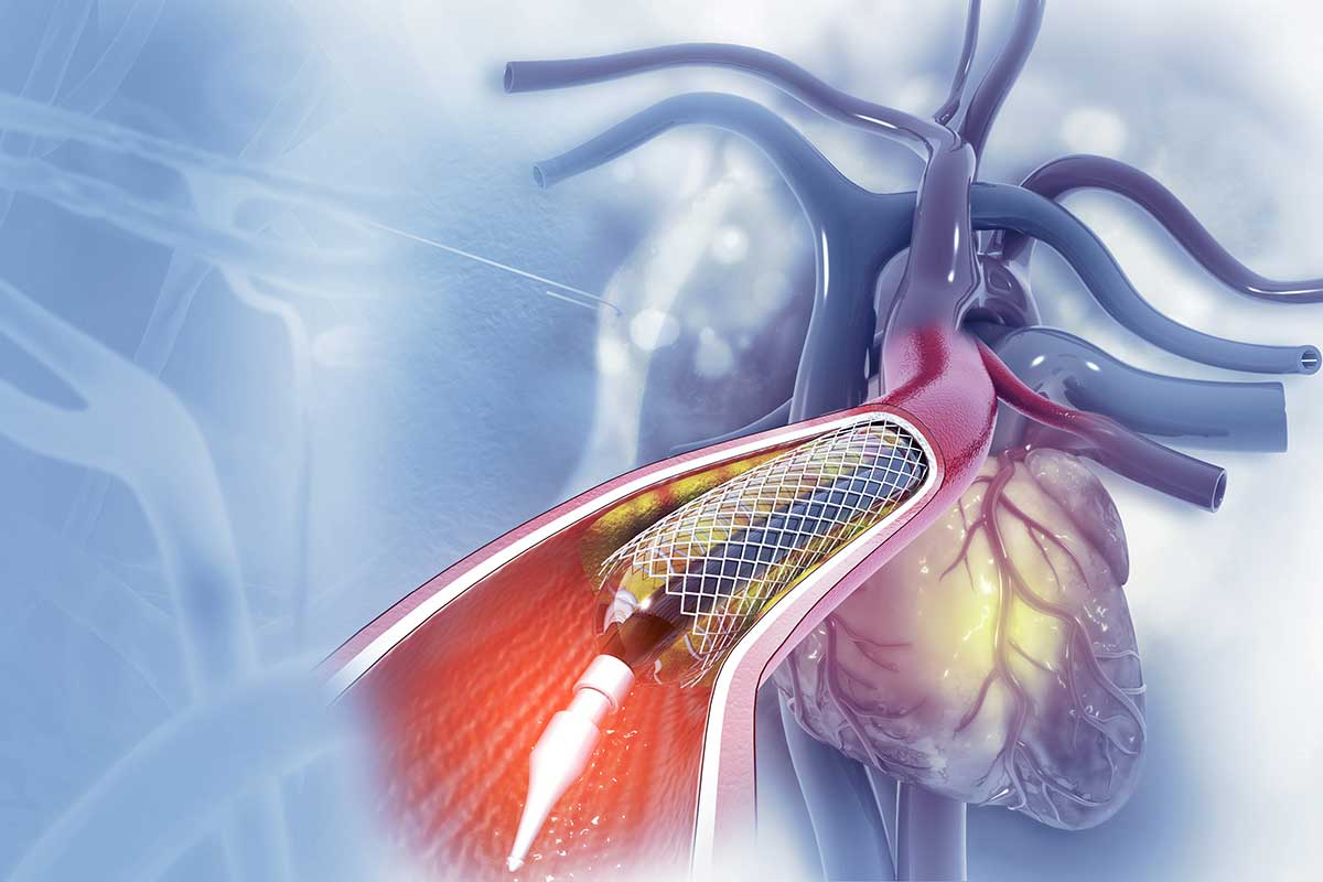 Angioplastia